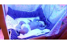 Sarılık Tedavisi Sarılık Tedavi Yöntemleri