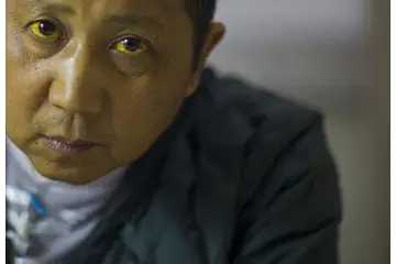 Sarılık Belirtileri ve Tedavisi