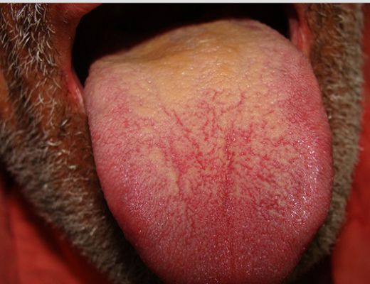 Dilde Sarılık Belirtileri ve Tedavisi