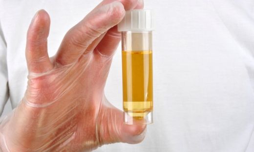 İdrarda Sarılık Belirtileri ve Tedavisi